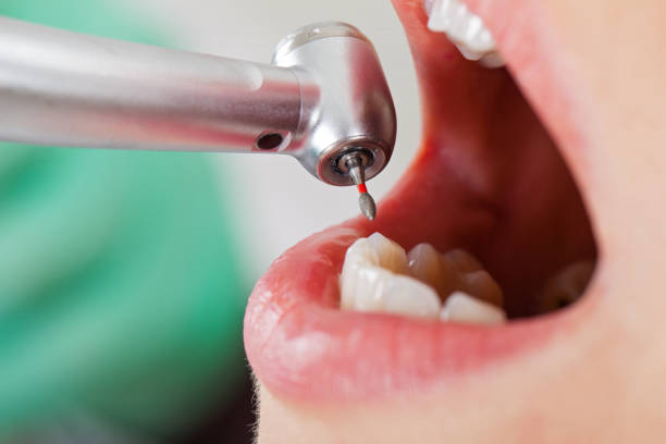 Best Emergency Root Canal Treatment in Middletown, CA